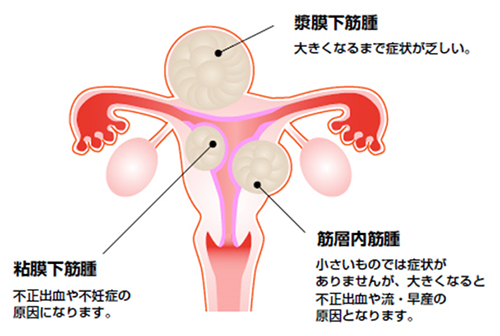 子宮筋腫-腫瘍の種類