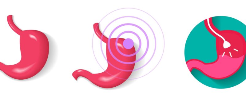 胃がんは抗がん剤治療をどう進める?胃がんで使われる抗がん剤や治療の進め方を解説